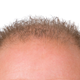 Image for article titled Scientists Just Took a Huge Step Towards Curing Baldness